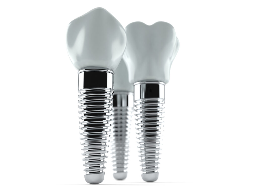dental implants lifestyle professionals Luka Dental Implants London Ontario
