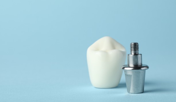 Dental implants in London Luka Dental Implants London Ontario