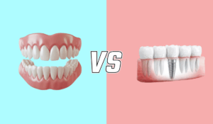 Dental implants vs dentures comparison Luka Dental Implants London Ontario